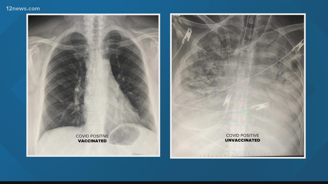 COVID-19: X-rays show vaccine efficacy on lungs - Vimarsana News