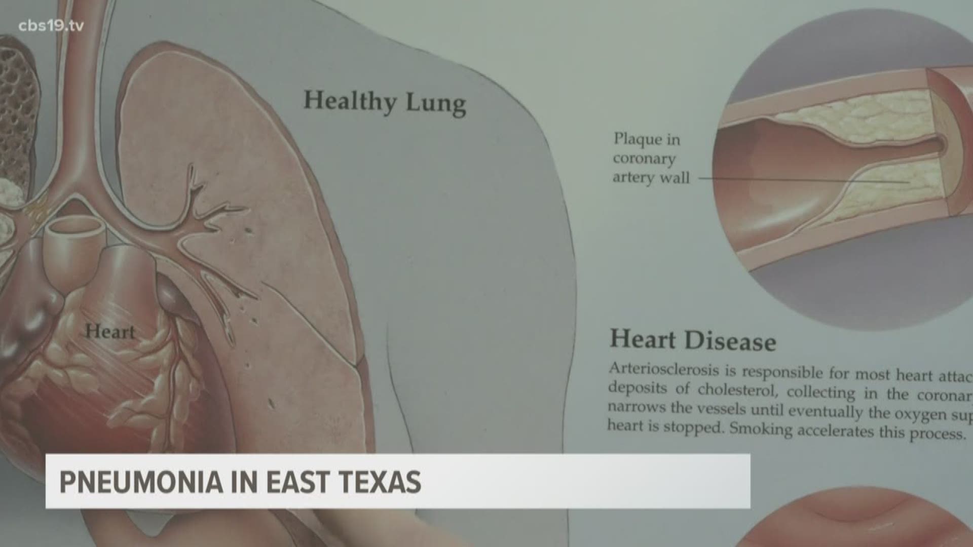 Pneumonia and potential risks