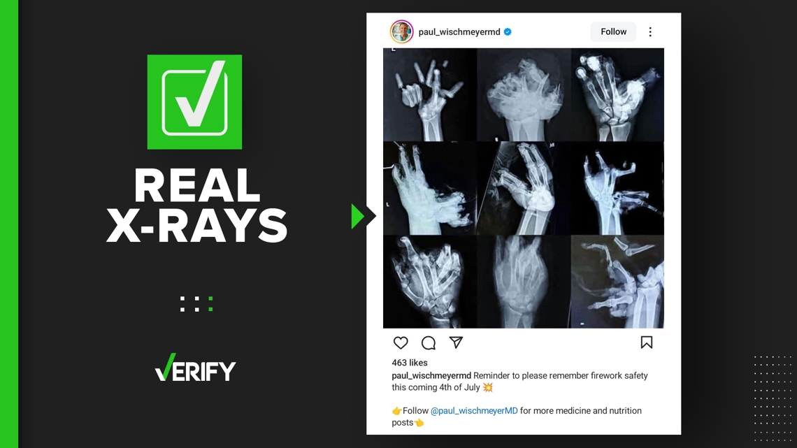 Hand Xray photo shows what real firework hand injuries look like