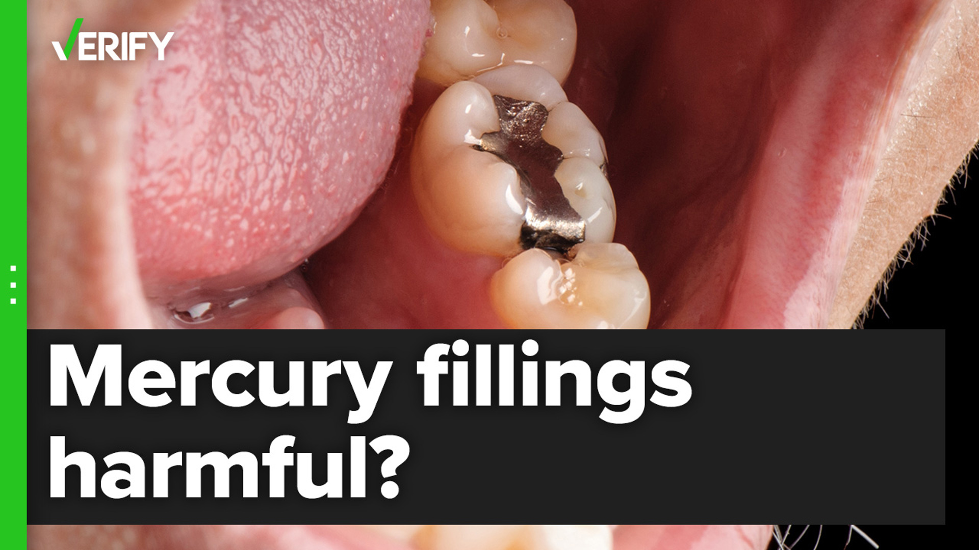 Dental amalgam is considered a safe cavity-filling material for most adults and children over the age of 6. But certain people should avoid getting fillings with it.