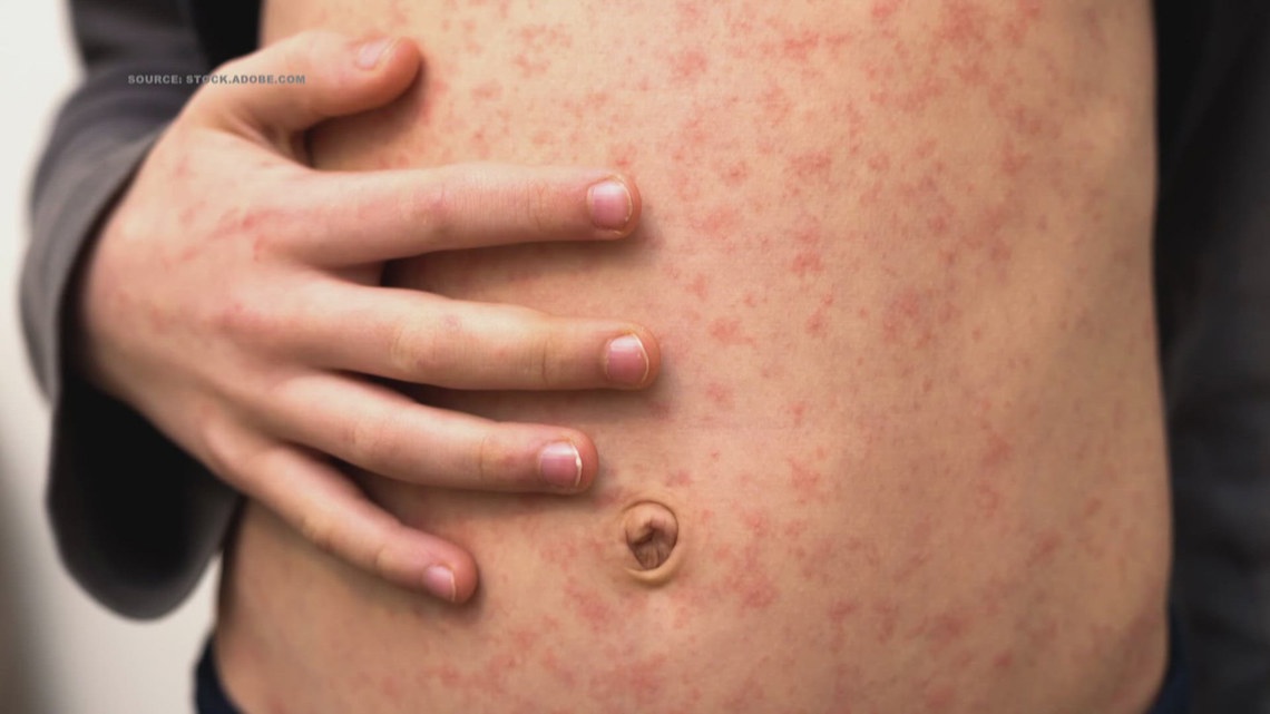 Two additional measles cases reported in North Carolina