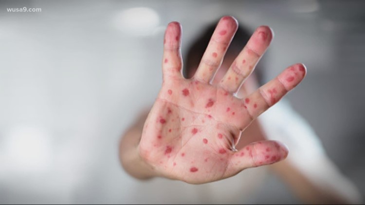 Virginia Health Dept. warns of possible measles exposures