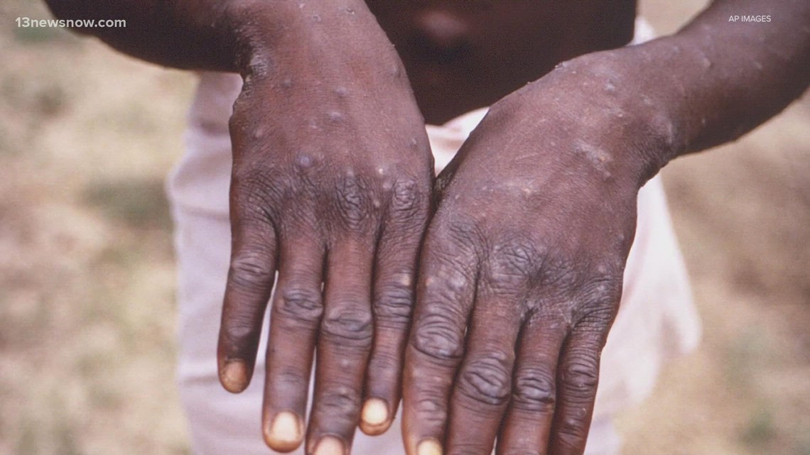 CDC says spread of monkeypox likely to happen - Vimarsana News