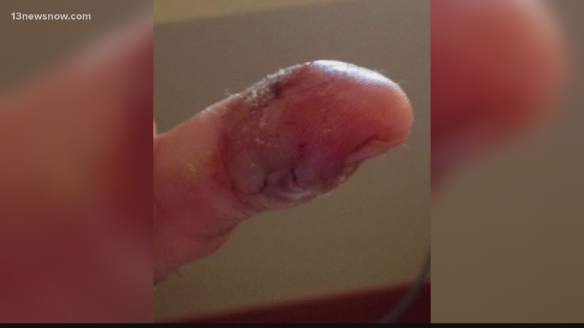 flesh eating disease finger