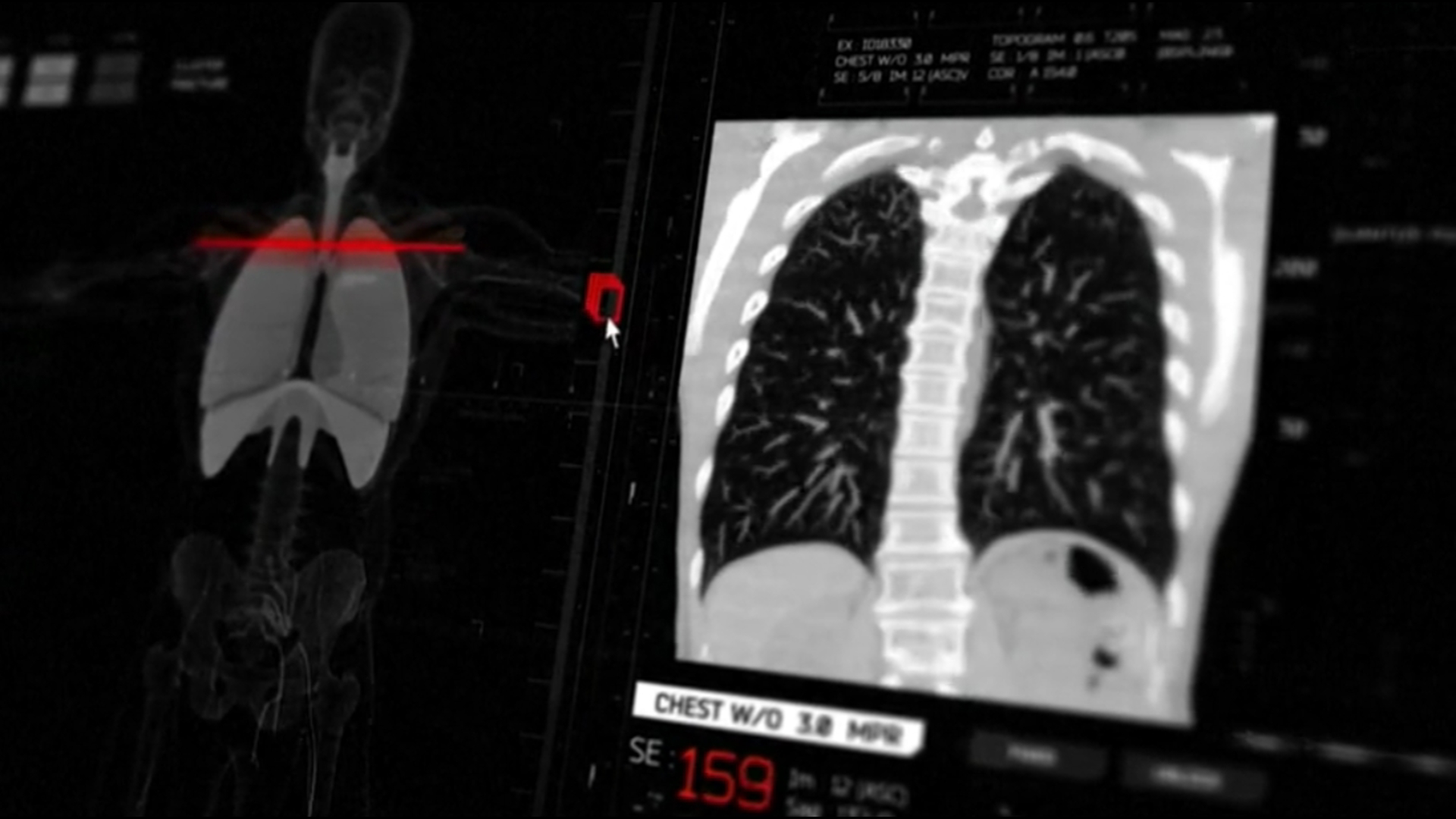 There are different types of tests available to detect lung cancer, including a relatively simple screening known as a low-dose CT scan.