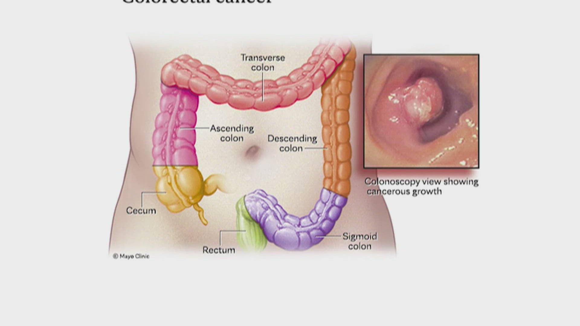 Colorectal cancer cases are rising among Millennials and Gen Z