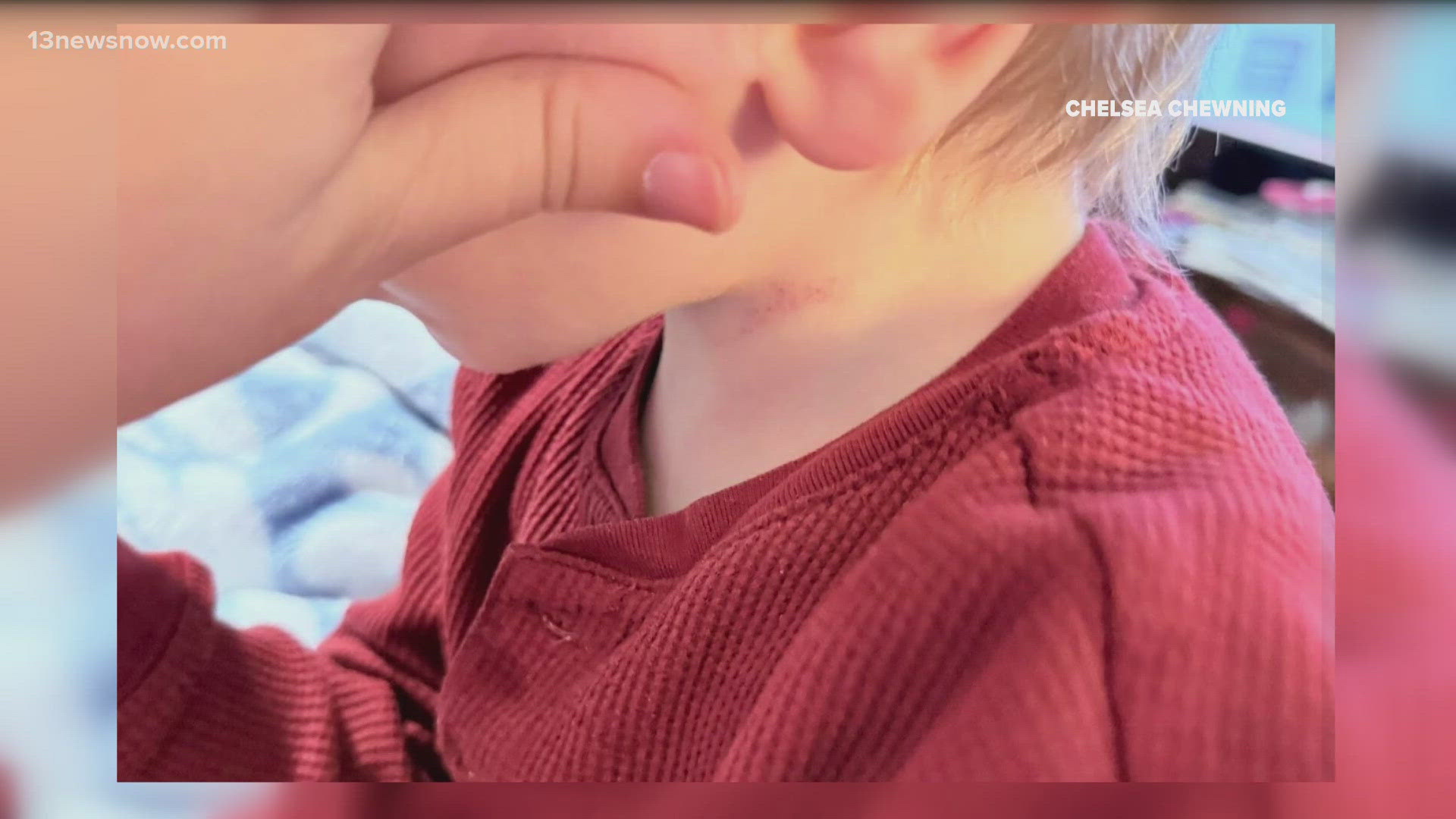 Franklin mom raises alarm over son's injury, says CPS