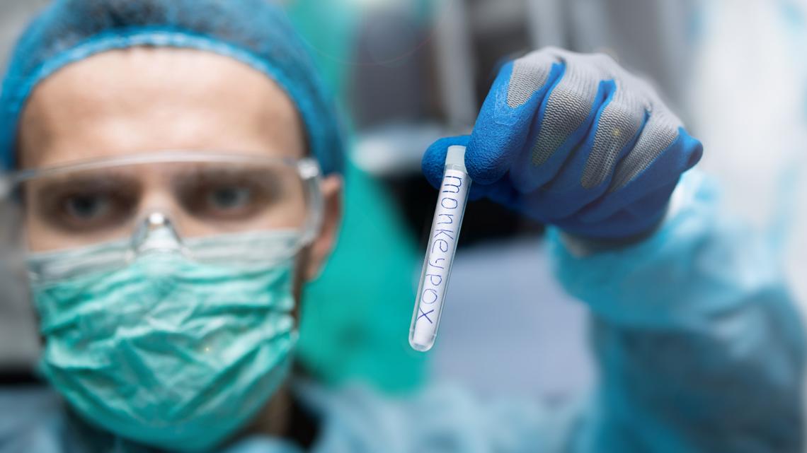 CDC ups testing as new monkeypox case reported in Virginia - Vimarsana News