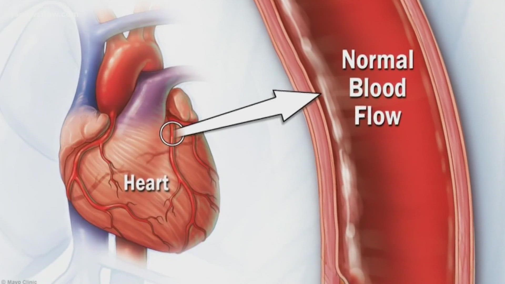 Coronary artery disease is the most common heart condition. More than 20 million people have it and more than 350,000 Americans have died from it